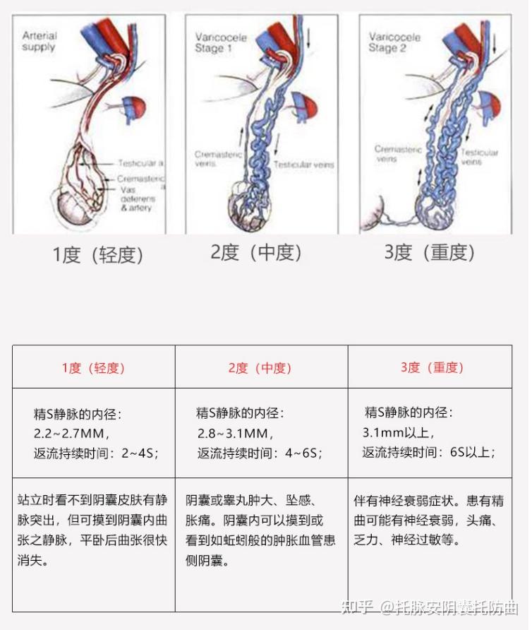 精索靜脈曲張三個程度圖詳解，精索靜脈曲張三個程度詳解圖解