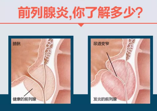 前列腺炎的治愈可能性，理解與探索，前列腺炎的治愈可能性，深入理解與探索