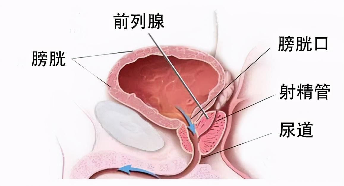 前列腺炎治療周期詳解，前列腺炎治療周期全面解析