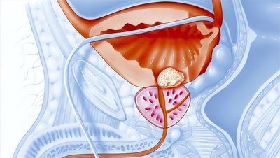 前列腺炎的治療費用分析，前列腺炎治療費用詳解